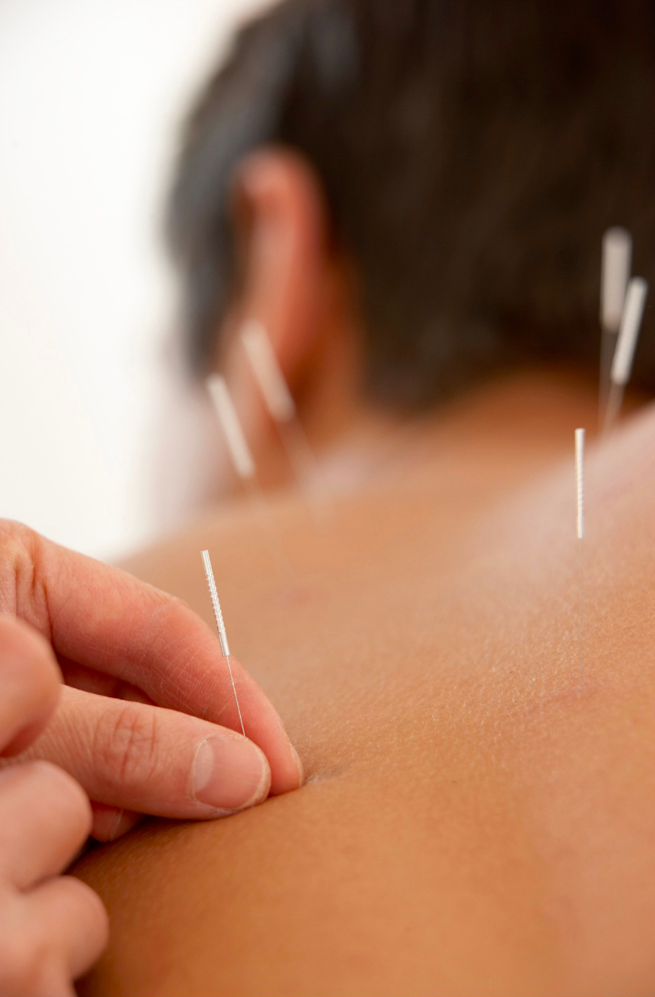 Acupuncture