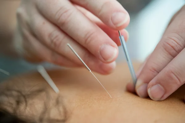 acupuntura en nerja